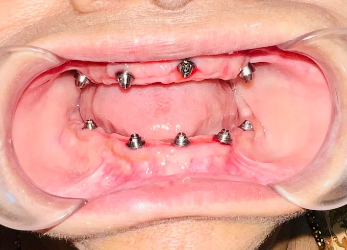 Successful dental work at Patel Dental Care CTM