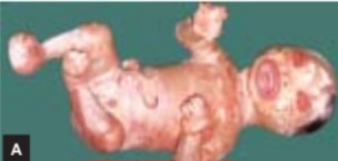 Clinical photograph showing a neonate with thick, rigid, plate-like scales covering the entire body, with deep fissures, ectropion, and eclabion, characteristic of harlequin ichthyosis