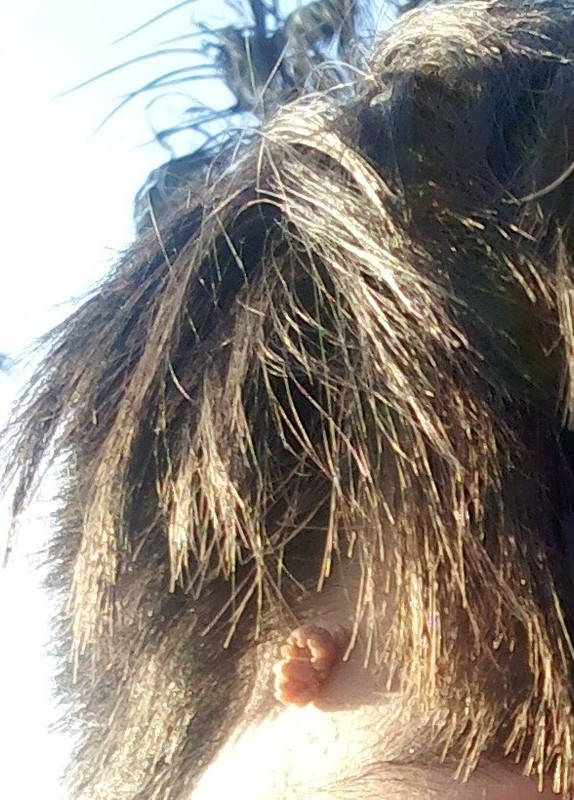 Me va a salir el grano padre en la nariz. Que puedo echarme?