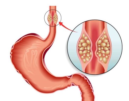 Esophageal Cancer: Causes, Symptoms, Treatments and Prevention – Medlife