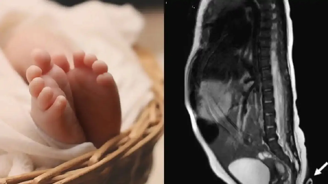 Bebé con “cola” sorprende a médicos en Guyana ¡Esto sabemos!