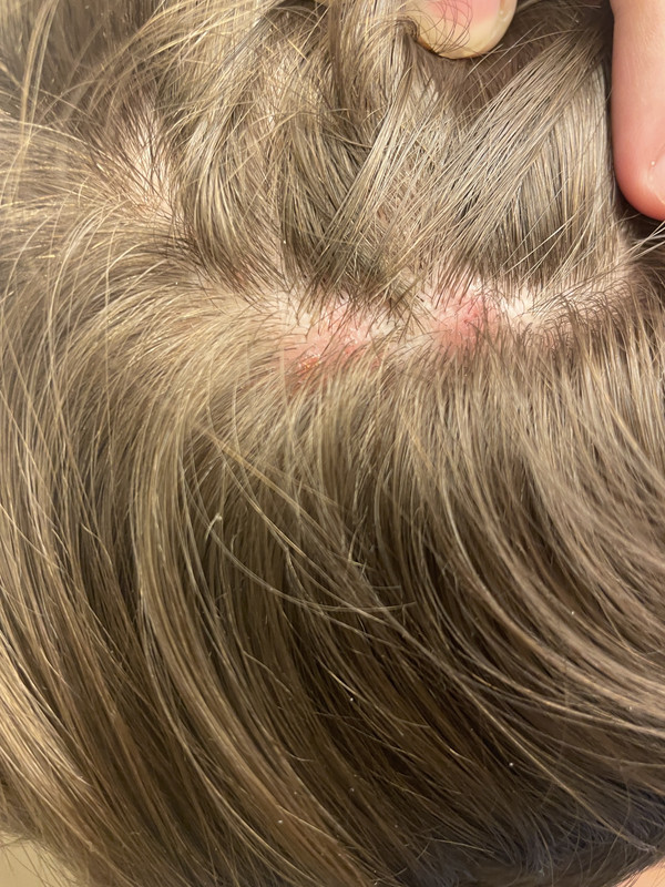 [28 M] Lymph nodes on one side of neck still painful and swollen from 2