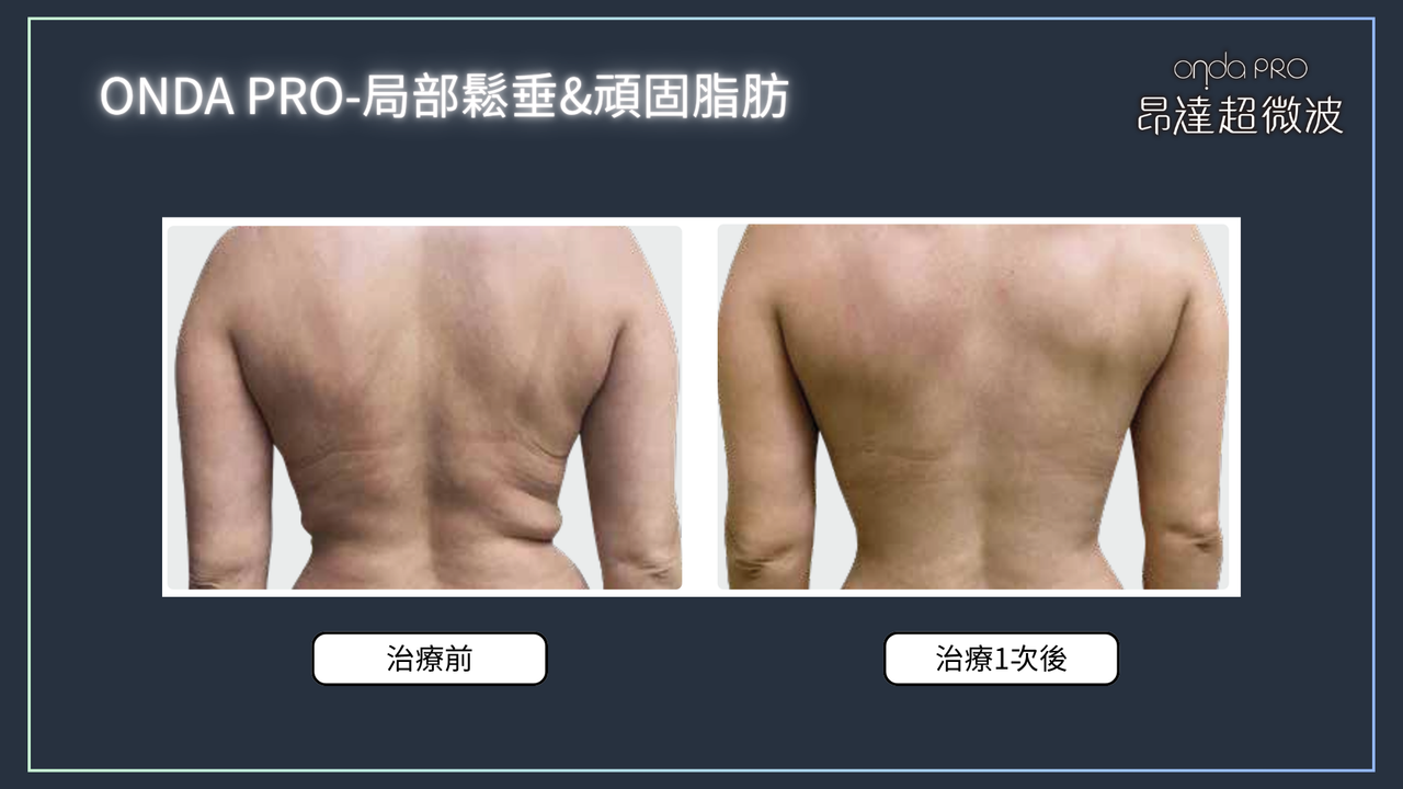 昂達超微波案例：側腰