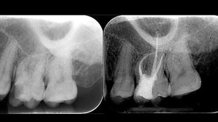 Basic Concepts for Endodontic Treatment