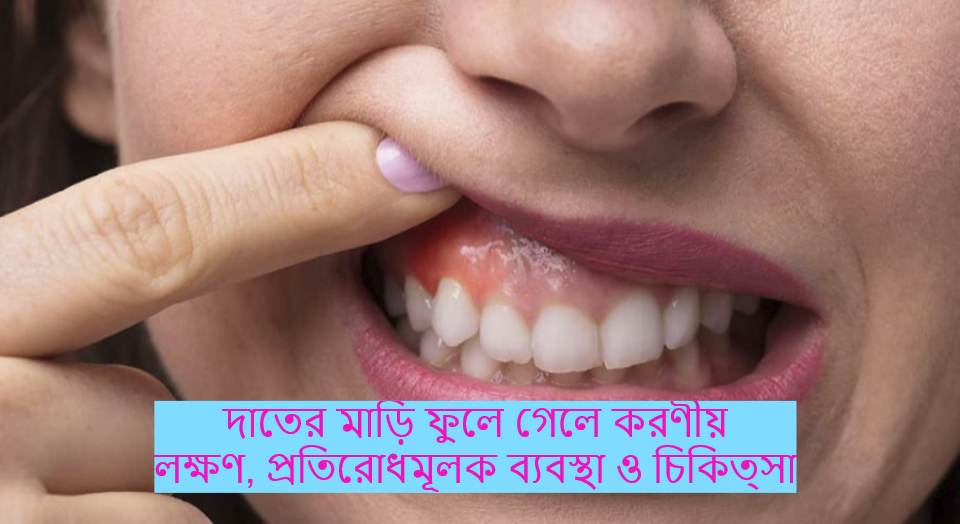 দাতের মাড়ি ফুলে গেলে করণীয় - লক্ষণ, প্রতিরোধমূলক ব্যবস্থা ও চিকিত্সা দাতের মাড়ি ফুলে গেলে করণীয় - লক্ষণ, প্রতিরোধমূলক ব্যবস্থা ও চিকিত্সা