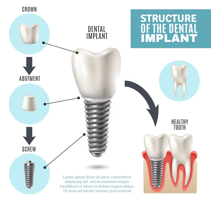 dental implant