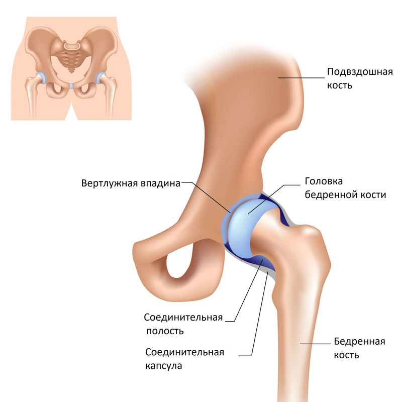 Перелом шейки бедра тазобедренного сустава