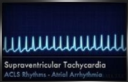 supraventricular tachycardia
