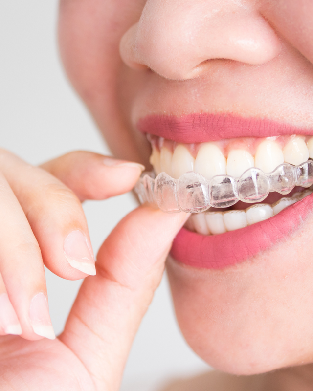 Invisalign Aligners