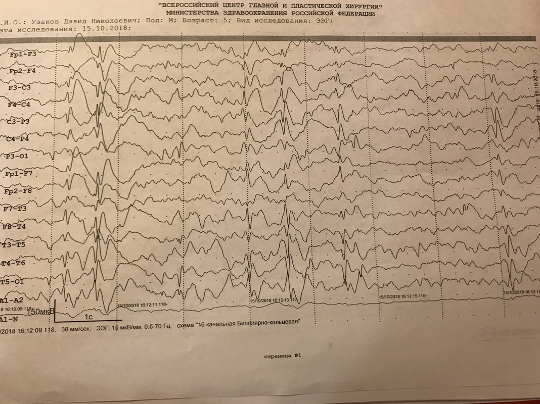 Расшифровка ээг у взрослого