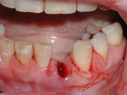 Tooth Extraction