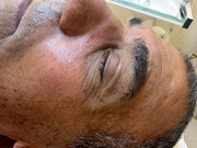 After treatment