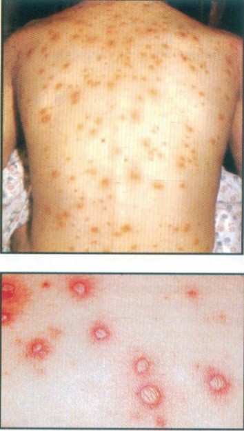 Clinical photograph showing a pruritic vesicular rash with lesions in various stages (vesicles, pustules, crusts) on the trunk, characteristic of varicella (chickenpox)