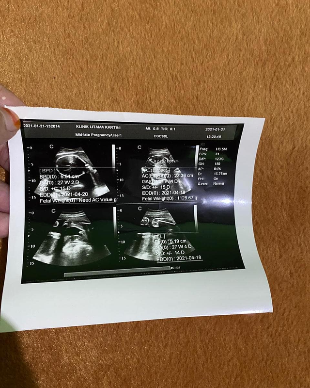 Nadya Mustika unggah foto hasil USG