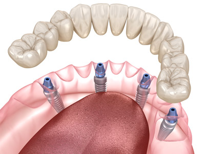 Dental Implant Structure and Missing Teeth Replacement