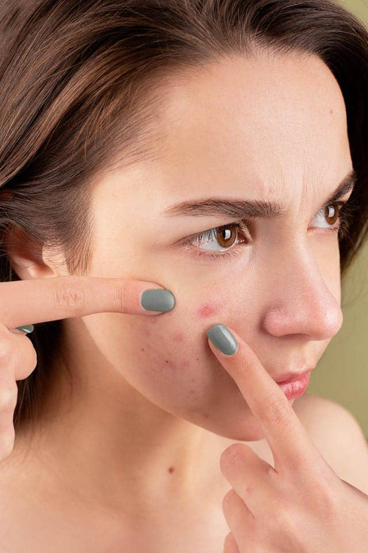 A girl touching acne on her face which is due to compromised skin barrier