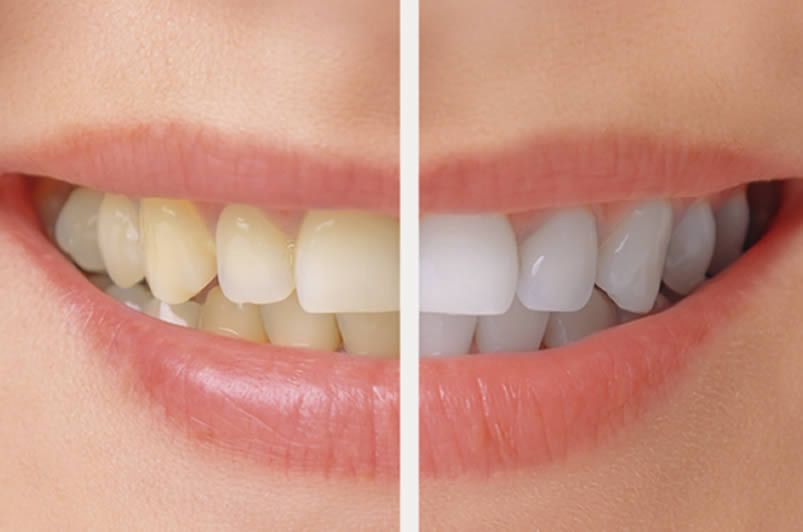 Evidence-Based Interpretation of Lumineers vs Porcelain Veneers in Contemporary Dentistry