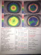 Occhio_sinistro_55_giorni_dopo_operazione