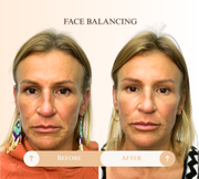 Facial balancing before and after result
