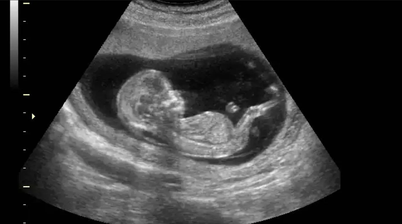 Brasil: Buscan abolir ley que obliga ver fotos del feto antes de abortar