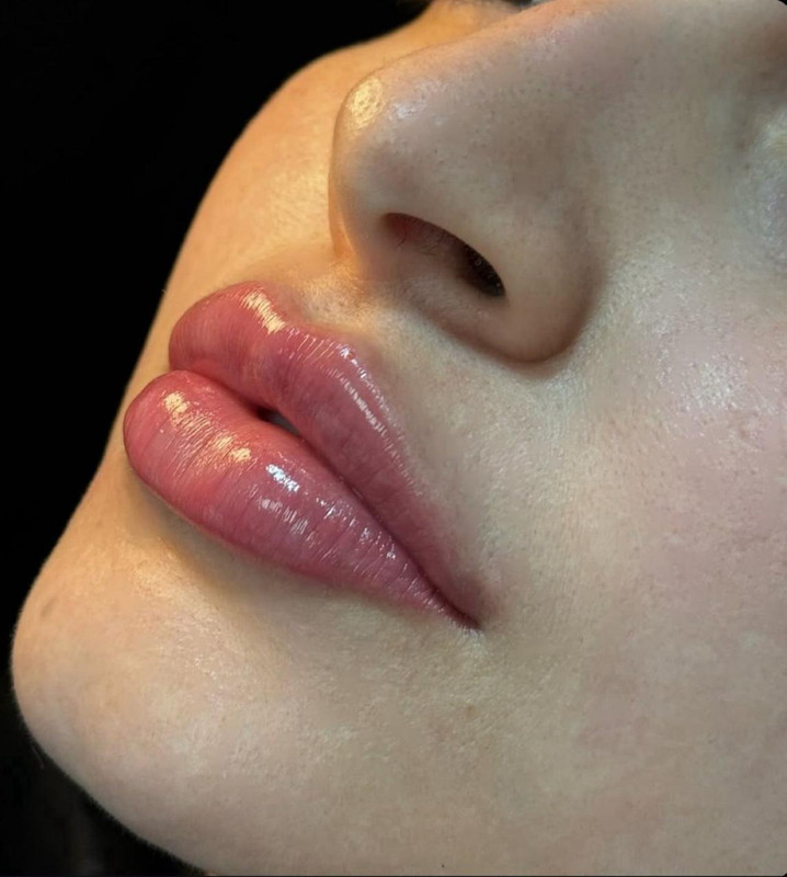 Preenchimento Labial