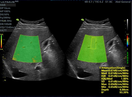 VINNO VATT (Vinno Attenuation) – сучасна ультразвукова технологія  визначення стеатозу