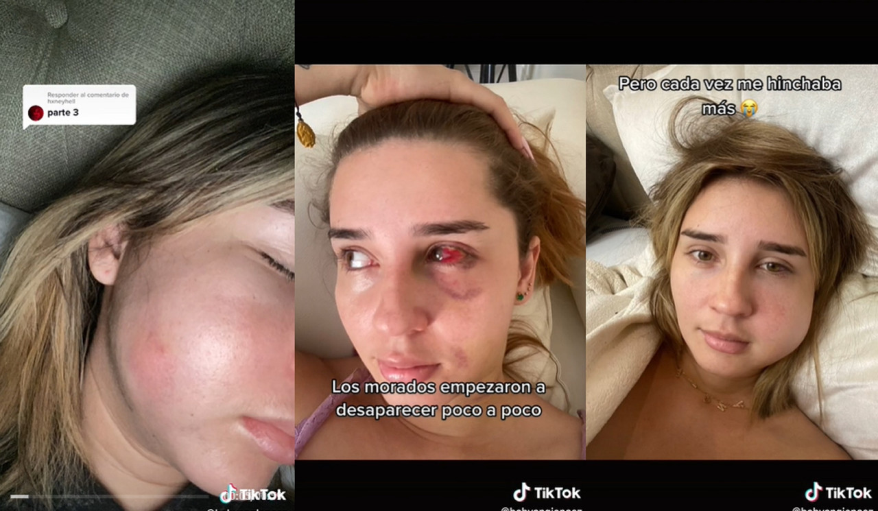 Bichectomía estuvo a punto de matar a una mujer ¿Qué le pasó?