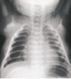 Chest X-ray showing hypoplastic or absent clavicles and a widened thorax, characteristic of cleidocranial dysplasia