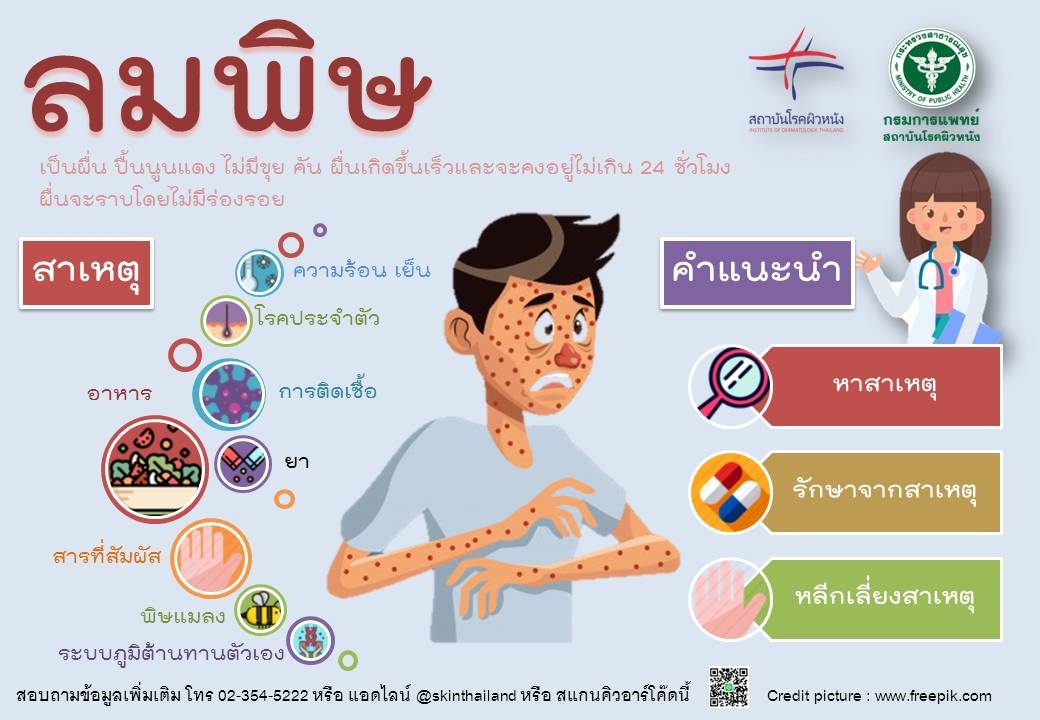 แพทย์ชี้โรคลมพิษต้องพยายามหาสาเหตุของโรคให้พบ
