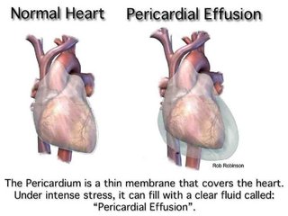 [Image: pericardial-effusion.jpg]