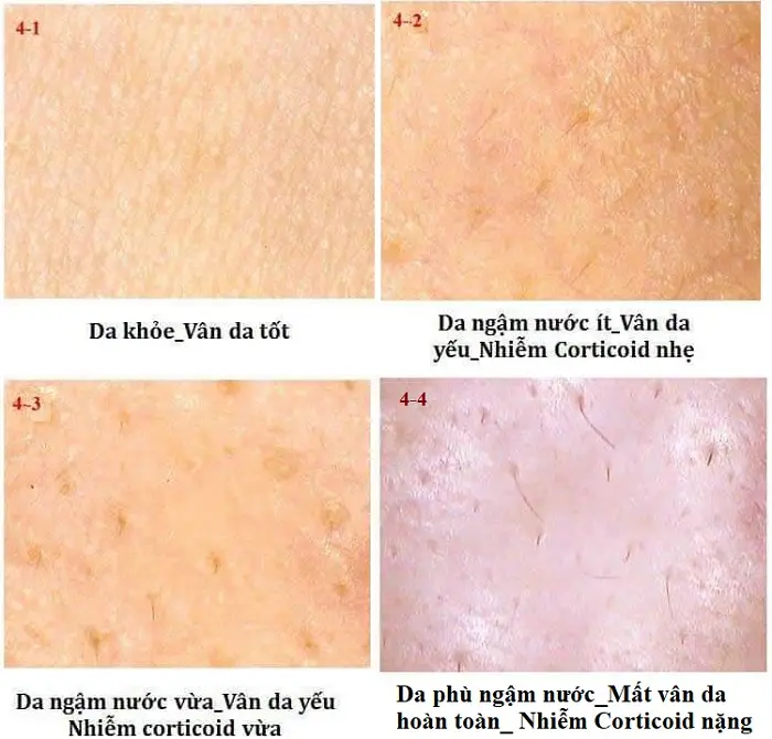 Cách điều trị da bị nhiễm Corticoid