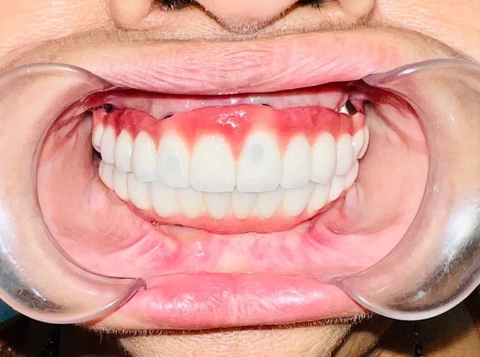 Before and after dental filling treatment at CTM dental clinic