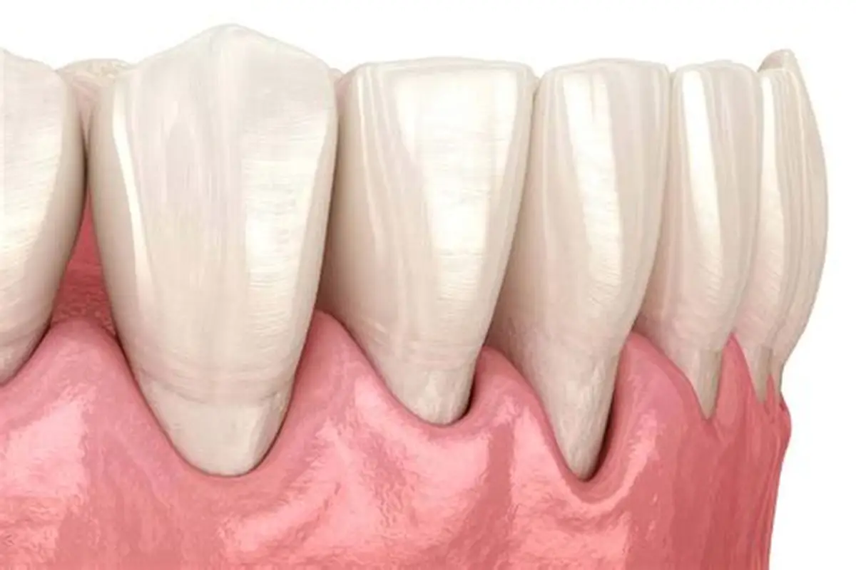 Dental examination of exposed tooth roots due to gum recession