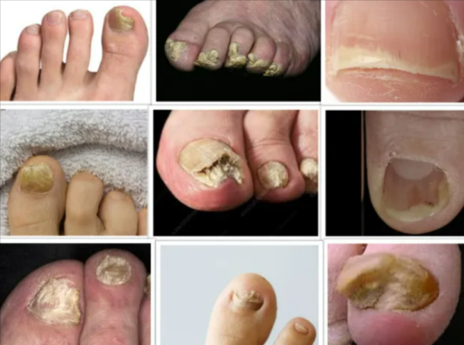 https://i.postimg.cc/63gk2gvQ/homemade-remedies-to-get-rid-of-toenail-fungus.png