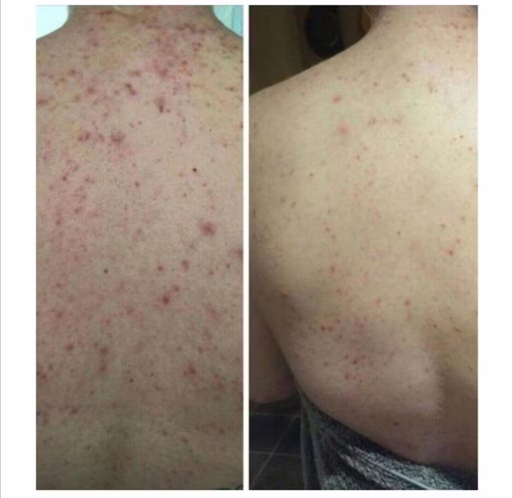 Resultados manchas cuello