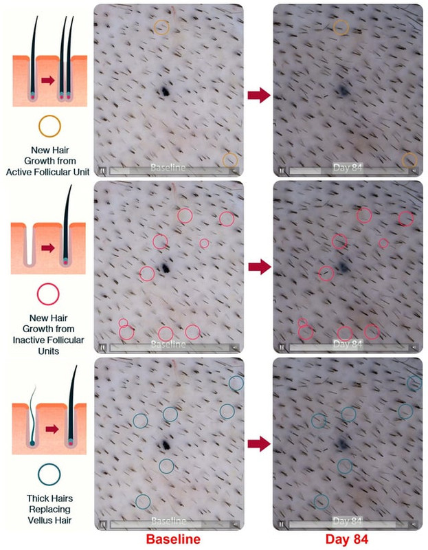 pelage pp405 new hair growth from inactive follicular units v0 4ghojtg7nvrg1