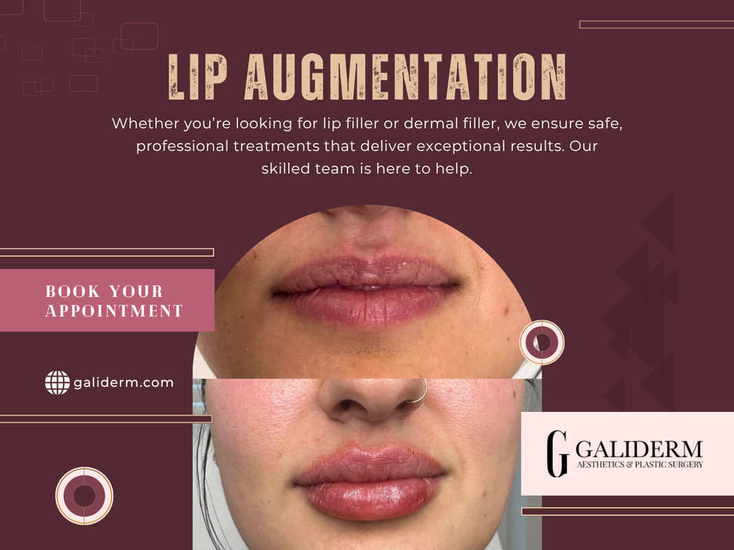 Lip Augmentation
