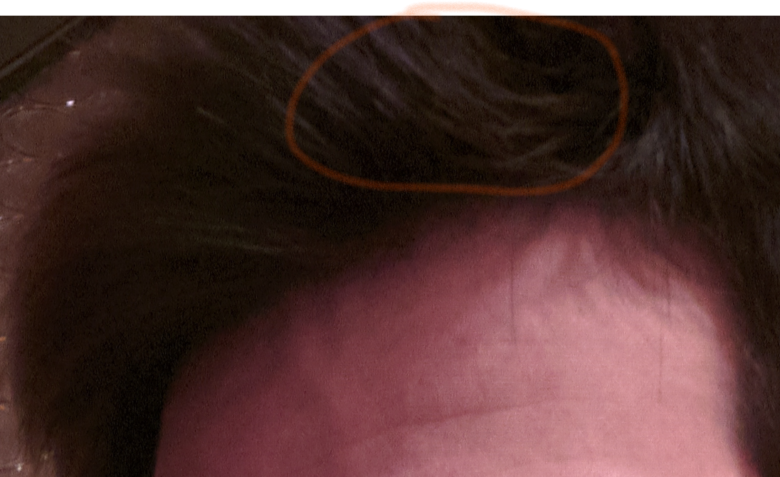 4. dicembre 2019. Tempia sx cerchiata