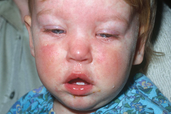 ca0811measles2-190338