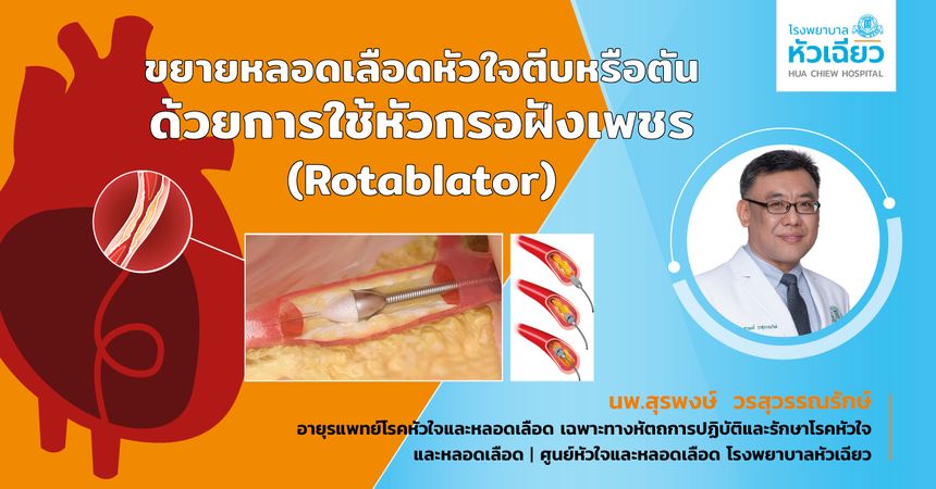 ขยายหลอดเลือดหัวใจตีบหรือตัน.. ด้วยการใช้หัวกรอฝังเพชร (Rotablator)