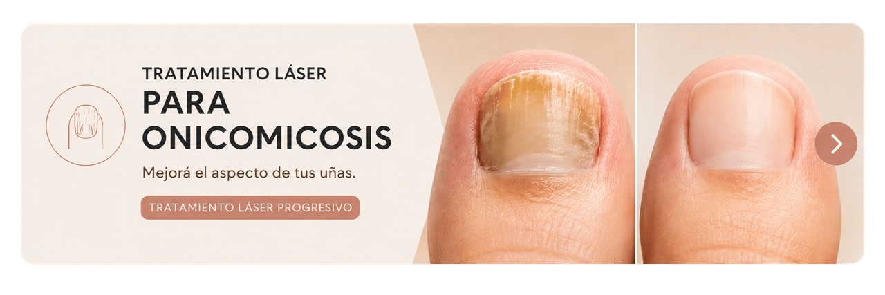 Banner tratamiento láser para onicomicosis en BELDAD Studio