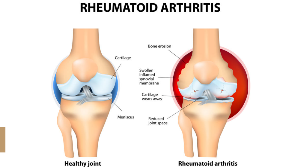 What is Rheumatoid Arthritis?