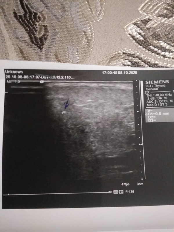 фото камня слюнной октябрь