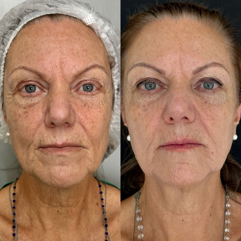 Resultado Rejuvenescimento