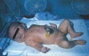 Exomphalos (omphalocele) - midline abdominal wall defect with membranous sac containing bowel and liver, cord insertion into sac
