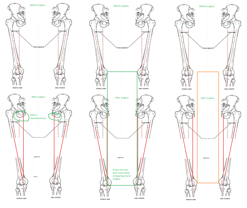 Femur lengthening and mechanical/anatomical axis angles