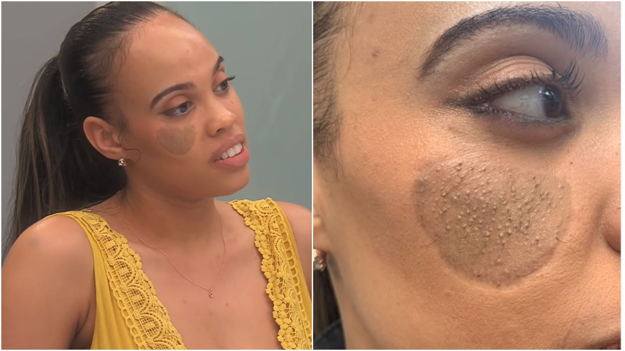 Médicos le injertaron piel de la ingle en el rostro y le crece vello púbico