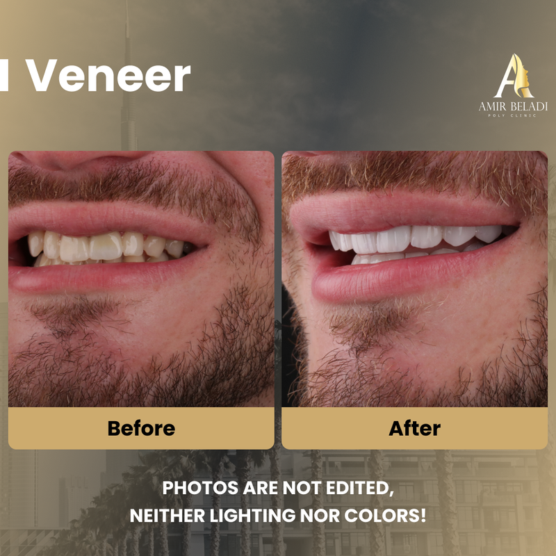 Before/After Smile 2