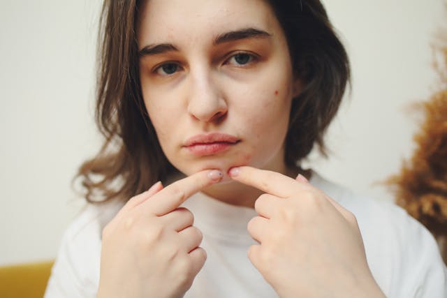A young woman touching her face with visible acne, redness, irritated, sensitive, and dehydrated skin, showing signs of a damaged skin barrier.