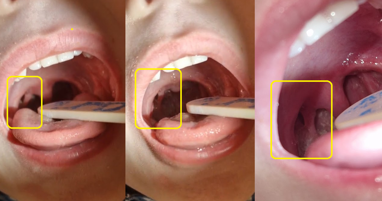 tonsil